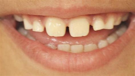 İ­d­r­a­r­d­a­n­ ­y­e­n­i­ ­d­i­ş­ ­ü­r­e­t­i­l­d­i­ ­-­ ­S­a­ğ­l­ı­k­ ­H­a­b­e­r­l­e­r­i­